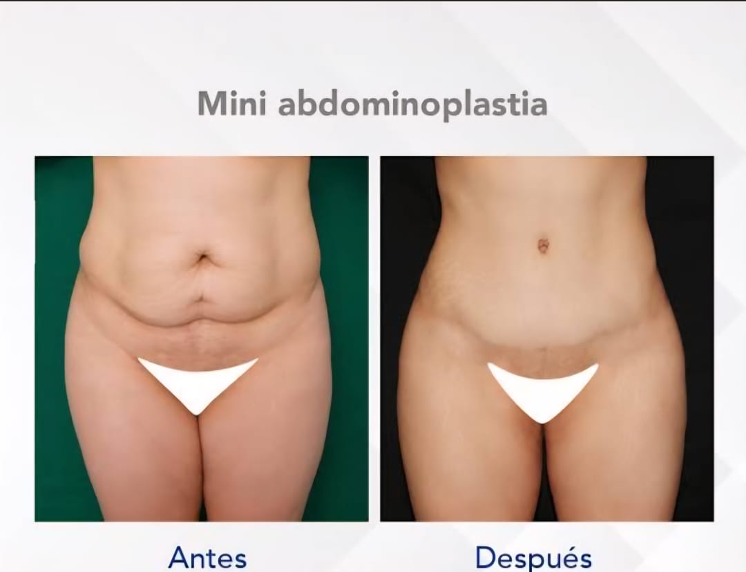 Resultado Miniabdominoplastia 6